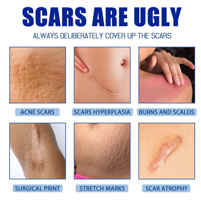 🔥Limited-time 60% sale--Scar Repair Cream — Smooth, Clear, Confident Skin