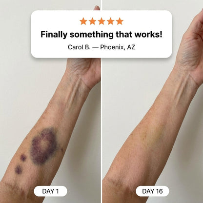 💥110K+ SOLD💕- MRAVION® Bruise Repair & Skin-Strengthening Cream
