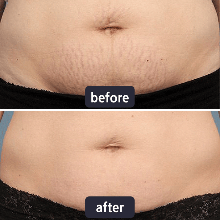 🔥Limited-time 60% sale--Scar Repair Cream — Smooth, Clear, Confident Skin
