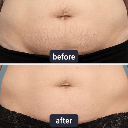 🔥Limited-time 60% sale--Scar Repair Cream — Smooth, Clear, Confident Skin
