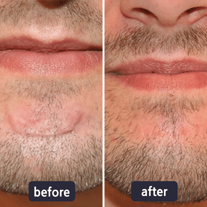 🔥Limited-time 60% sale--Scar Repair Cream — Smooth, Clear, Confident Skin