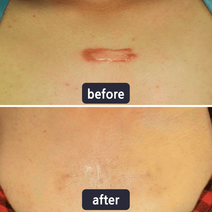 🔥Limited-time 60% sale--Scar Repair Cream — Smooth, Clear, Confident Skin